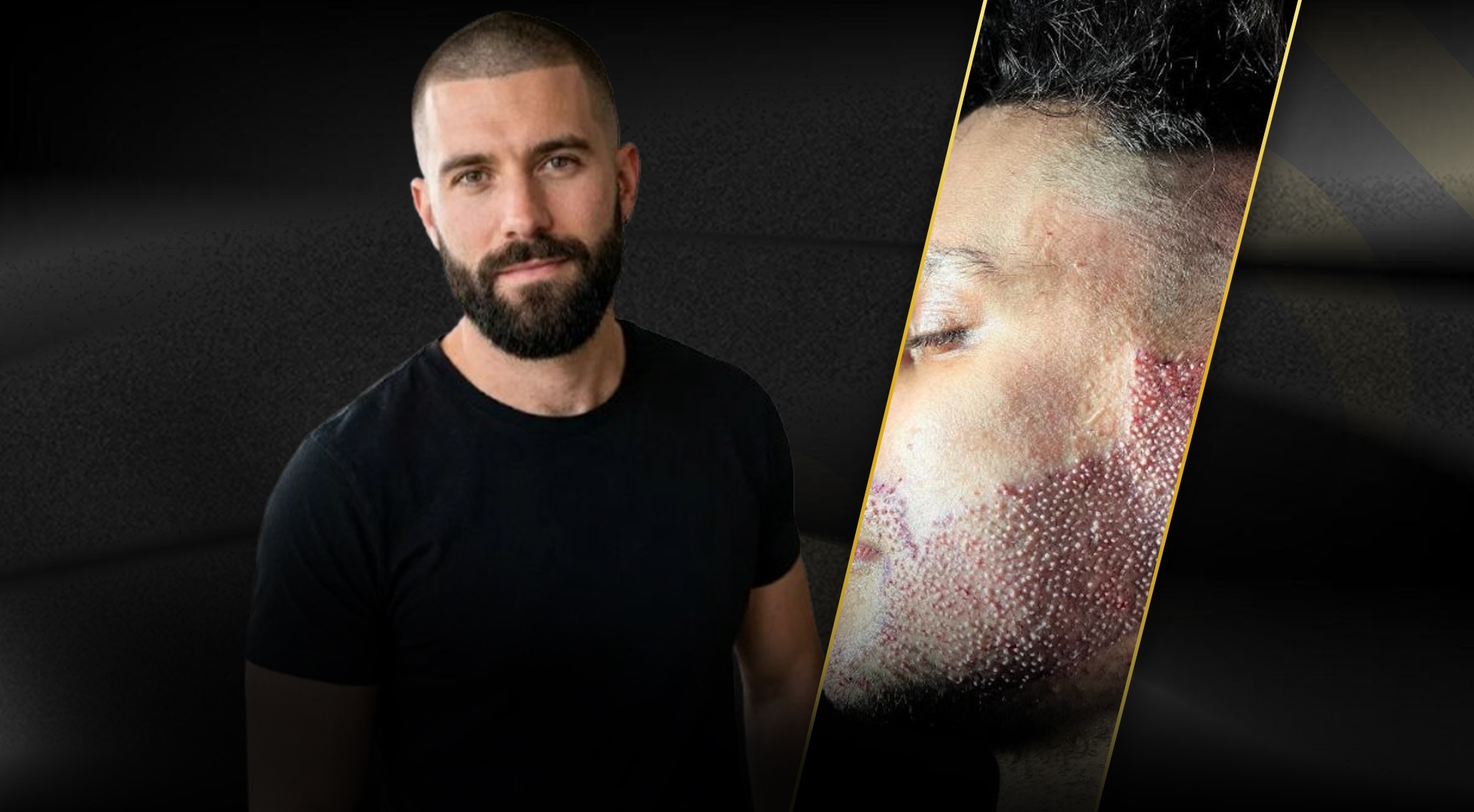Beard Transplant: Everything You Need to Know