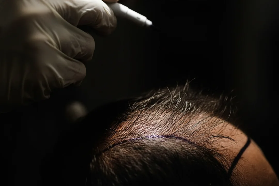 Hair Transplant