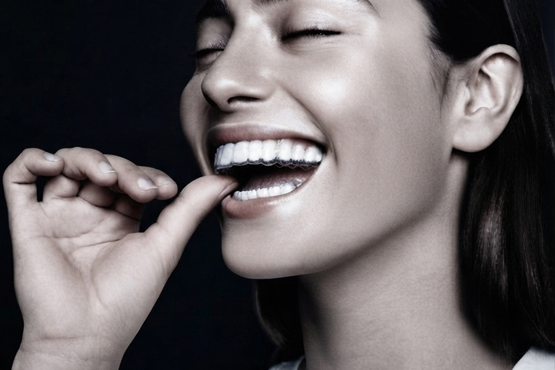 Invisible Aligners (Orthodontics)